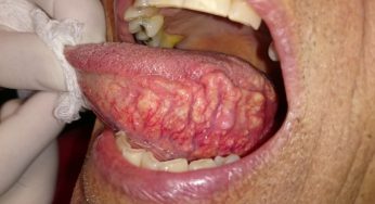 Amyloidosis Oral: Ketika Protein Mengganggu Kesehatan Mulut