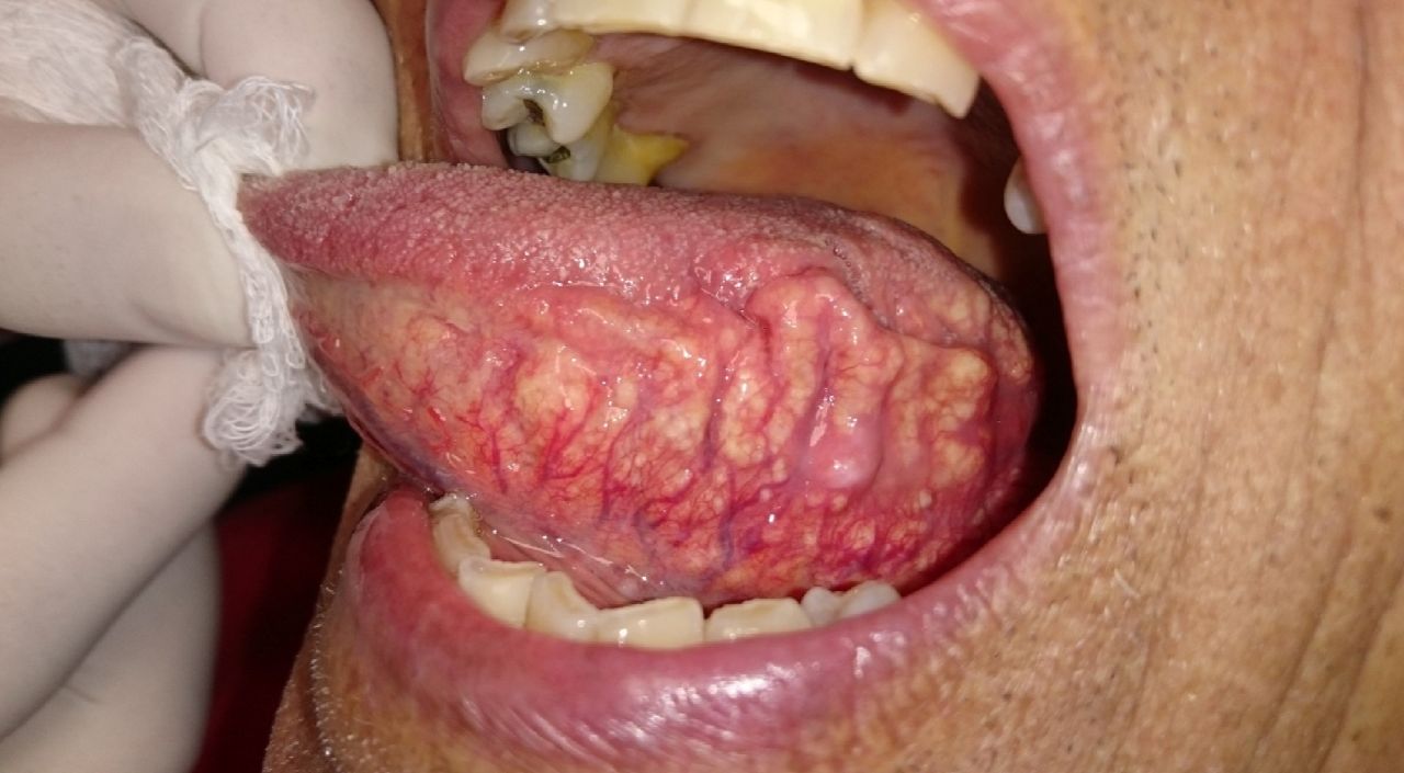 amyloidosis oral